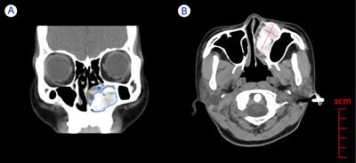 Refractory and progressively worsening nasal obstruction: case report of nasal osteoblastoma and literature review
